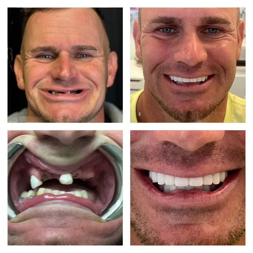 Smile transformation result 8